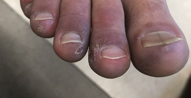 purple-feet-diabetes