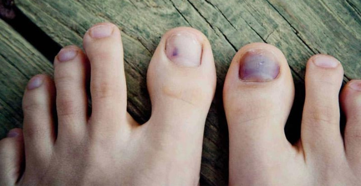 Black-Toenails-and-Diabetes