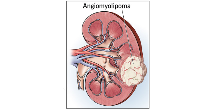 angiomyolipoma-kidney angiomyolipoma-kidney