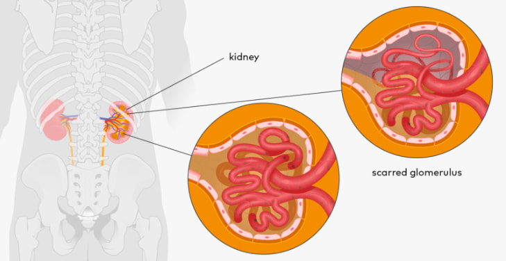 fsgs-kidney-disease fsgs-kidney-disease
