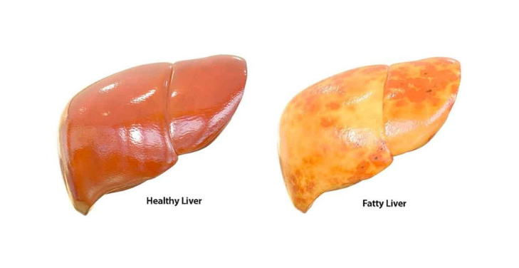 fatty-liver fatty-liver