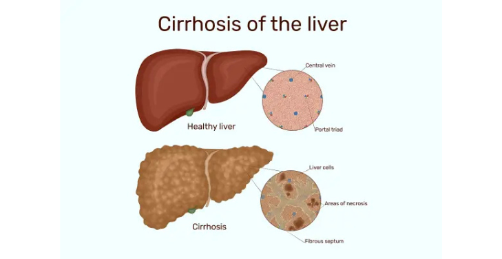 liver-cirrhosis liver-cirrhosis