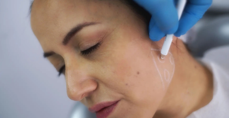 sculptra-pros-and-cons