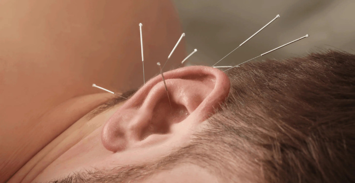 can-acupuncture-help-tinnitus