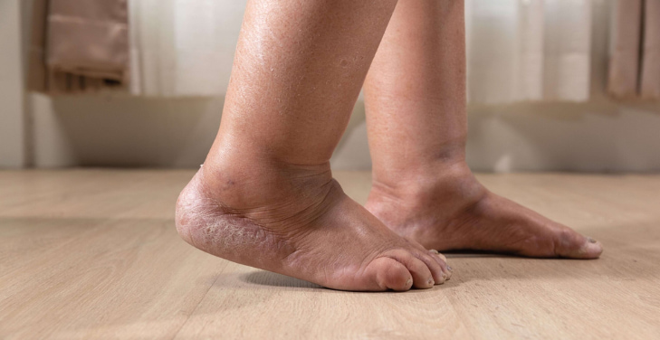 dangers-of-edema-in-legs
