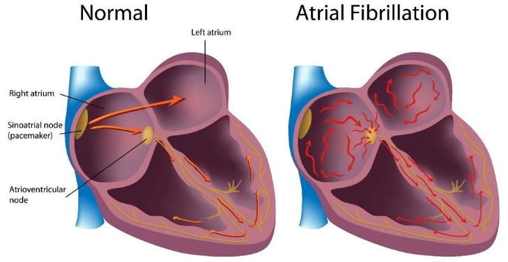 dangers-of-afib